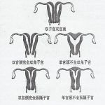 子宫畸形的症状之反复流产
