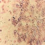 想治好阴道炎必须尊守五大治疗原则