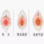 关于处女膜修复