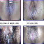 小阴唇过大/小阴唇不对称怎么办?