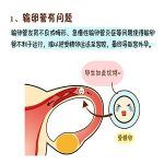 输卵管不通病因之输卵管先天性发育不良