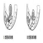 阴道闭锁症状