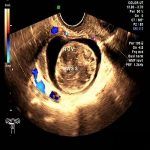 卵巢囊肿盆腔全景超声