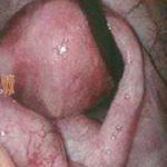 输卵管积水引发的不孕是否能做试管婴儿？