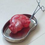 卵巢囊肿开腹手术