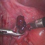 北京安太医院治疗宫外孕特色技术