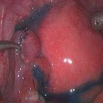 得过宫外孕再怀孕注意事项