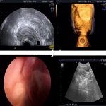 异位妊娠宫外孕之腹腔镜检查