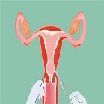 上环的不同时机