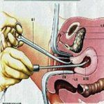 宫腔粘连病因之宫腔操作史