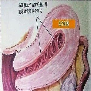 梨形支架可以预防人流后宫腔粘连