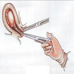 人流后没来月经，需要复查吗？