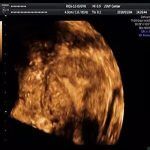 宫腔粘连全景彩超检查