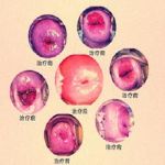 宫颈糜烂宫颈刮片TCT检查