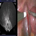 异位妊娠宫外孕三D腹腔镜取胚除病因