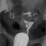 宫腔粘连检查动态数字化子宫输卵管造影