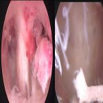 宫腔粘连为啥越治越重呢？