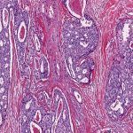 宫颈上皮内瘤变 CIN怎么治疗