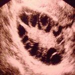 多囊卵巢综合征相关检查