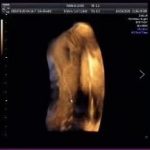 B超下胎背有高光带是什么情况?