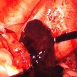 惊心！朋友持续腹痛只因“宫外孕”