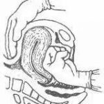 产后出血 慎用子宫按摩