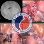 习惯性流产后不孕怎么办？