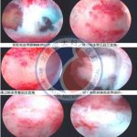 哪些习惯性流产的人才需要做代孕？