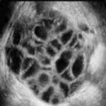 试管婴儿移植后腹水怎么办?