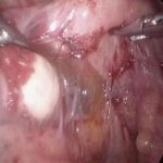 盆腔粘连与习惯性流产