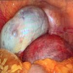 孕后巨大卵巢囊肿切除保胎术