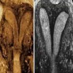 晚期流产病因子宫畸形_创新技术之子宫扩大术