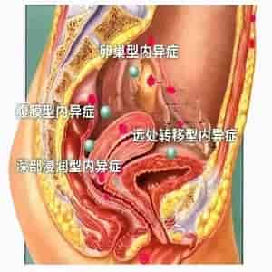 子宫内膜异位