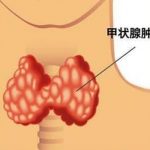 甲状腺功能亢进反复流产怎么办呢?