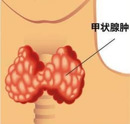 甲状腺功能亢进反复流产