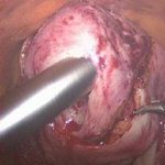 子宫腺肌症切除子宫是不是唯一的办法?