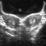 【疑问】复发性流产在怀孕前能否找到病因?