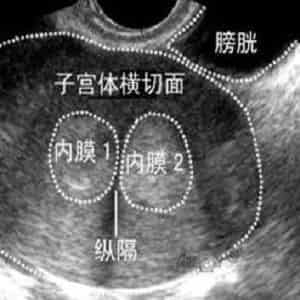 子宫纵隔