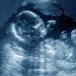 畸形胎儿与习惯性流产有没有关联，是胎儿畸形就会流产吗?