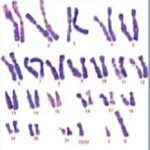 染色体平衡易位好治吗?