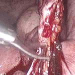 应用3D腹腔镜治疗子宫内膜异位症是否能够彻底?