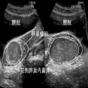 卵巢巧克力囊肿