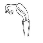 单角子宫是否可以正常怀孕生孩子?