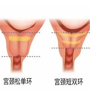 宫颈短,双安太环