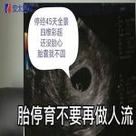 【视频】秒懂胎停育,胎停育只能做试管婴儿?