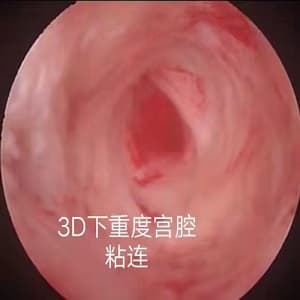 宫腔粘连