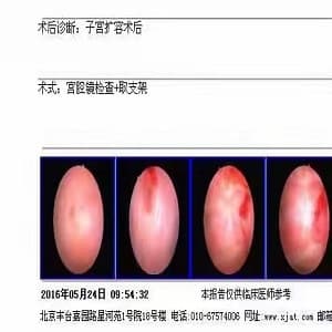 始基子宫,幼稚子宫