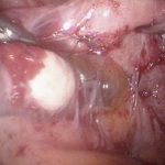 【视频】盆腔粘连为何会导致习惯性流产?