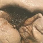 【视频】畸胎瘤会导致胎儿流产吗？