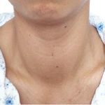 【视频】甲状腺功能亢进会导致流产吗?